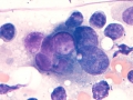 Urothelial carcinoma