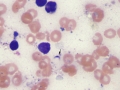 Toxoplasmosis