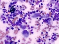 Melanoma