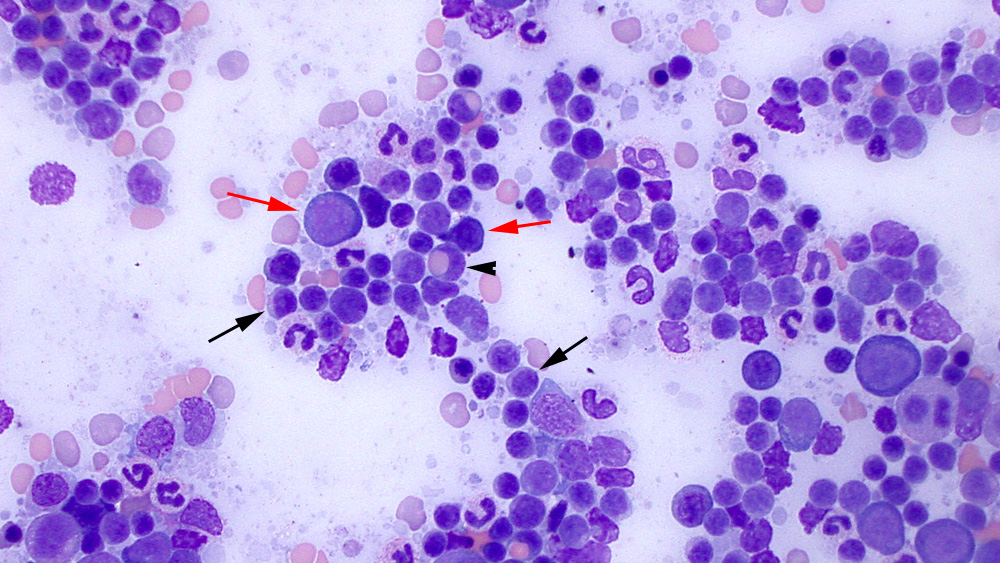 Lymphoma of granular lymphocytes