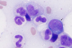 Lymphoma
