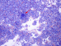 Lymphoma of granular lymphocytes (GL, dog)
