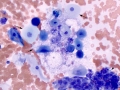 Prostate squamous metaplasia