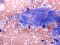 Prostatic hyperplasia and squamous metaplasia