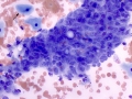 Prostate hyperplasia & squamous metaplasia