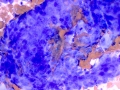 Prostate hyperplasia