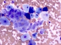 Prostate squamous metaplasia