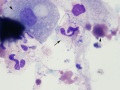 Prostatitis