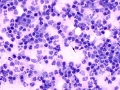Prostatitis