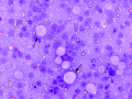 Seminoma
