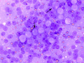Seminoma