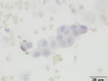Urothelial carcinoma (ALP stain)