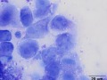 Urothelial carcinoma