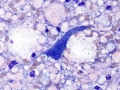 Myelomalacia