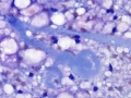 Myelomalacia