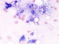 Myelomalacia