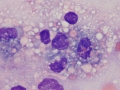 Myelomalacia