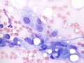 Myelomalacia