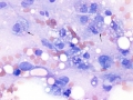 Myelomalacia