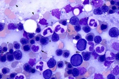 Normal marrow
