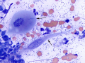 Squamous cell carcinoma