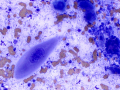 Squamous cell carcinoma