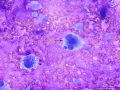 Chondrosarcoma