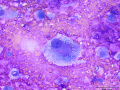 Chondrosarcoma