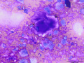 Chondrosarcoma