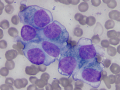 Melanoma