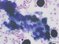 Melanoma