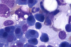 Other neoplasia