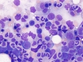 Histiocytic sarcoma (dog)