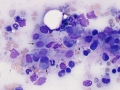 Histiocytic sarcoma (dog)