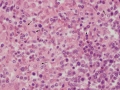 Histiocytic sarcoma (dog, H&E)