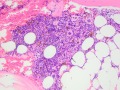 Multiple myeloma (dog, H&E)