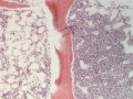 Hemophagocytic histiocytic sarcoma (dog, H&E)