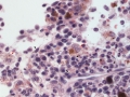 Hemophagocytic histiocytic sarcoma (dog, H&E)
