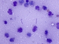 Abscess