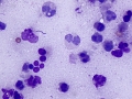 Abscess