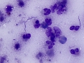 Abscess