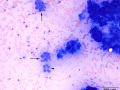 Inflammation