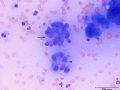 Inflammation