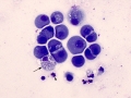 Pericarditis
