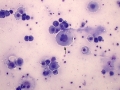 Pericarditis