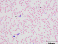 Hypochromasia & polychromasia