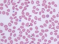 Poikilocytosis & Heinz bodies