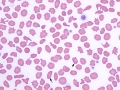 Poikilocytosis & Heinz bodies