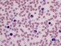 Reactive lymphocyte & monocyte