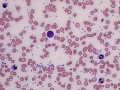 Neutrophil & reactive lymphocyte